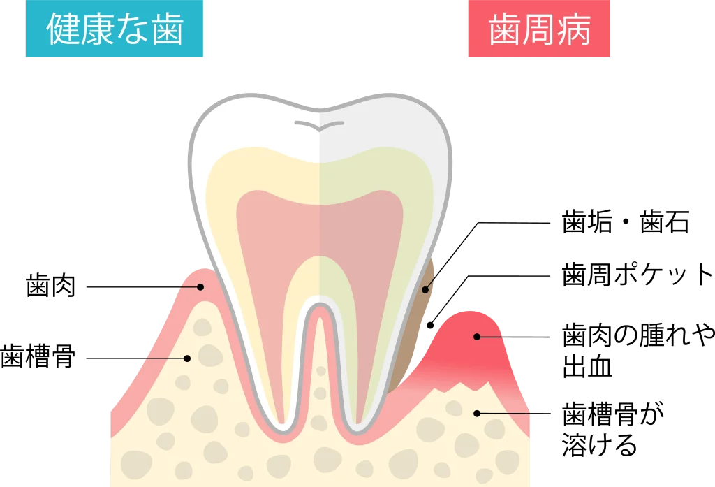 歯周病の仕組み