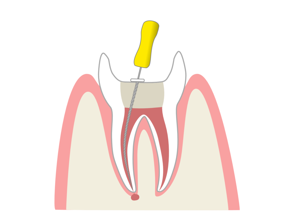 抜髄：炎症を起こした歯髄を取る治療