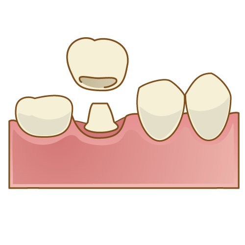 歯の被せ物