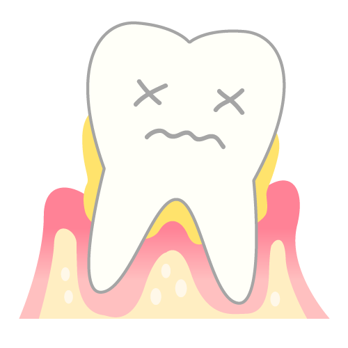 歯周病とは