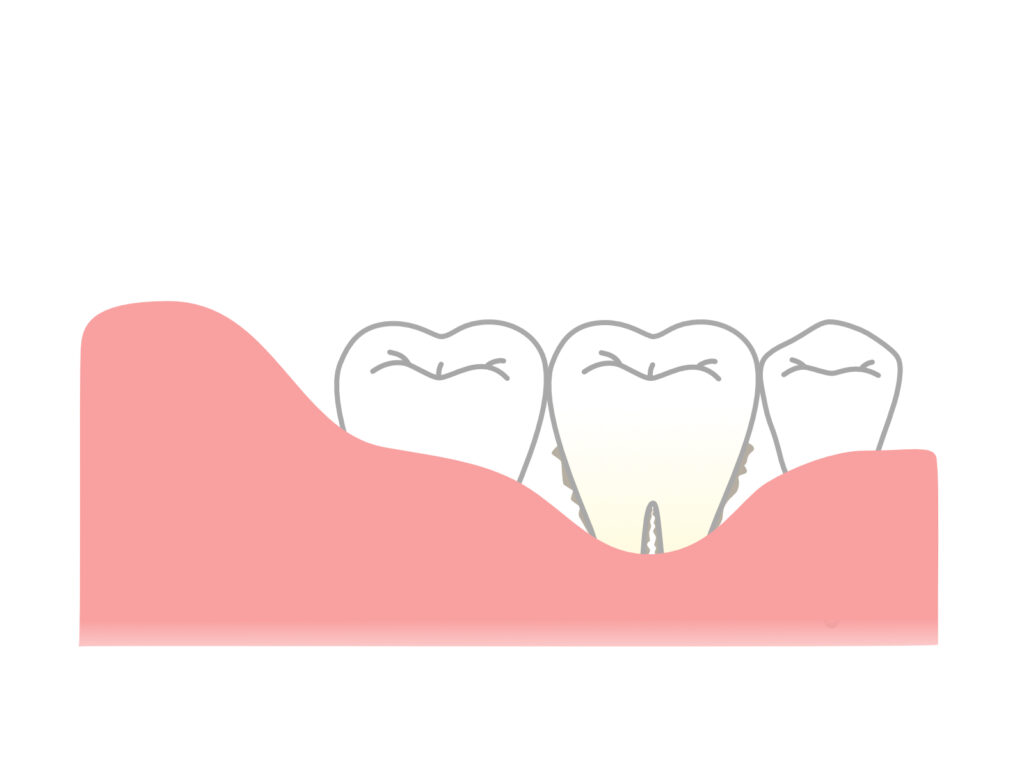 歯周病とは感染症で人にも移る