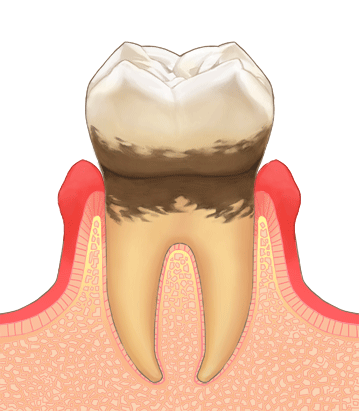 歯の周りの骨が部分的に溶けているケース