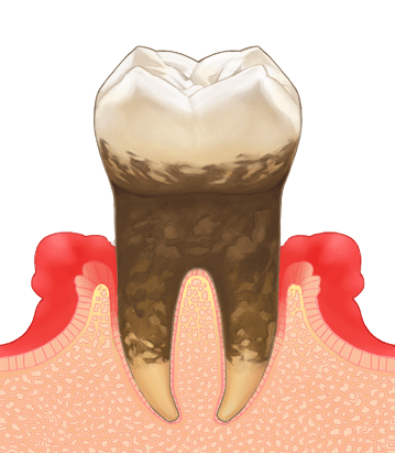 歯の周りの骨が半分ぐらい残っているケース
