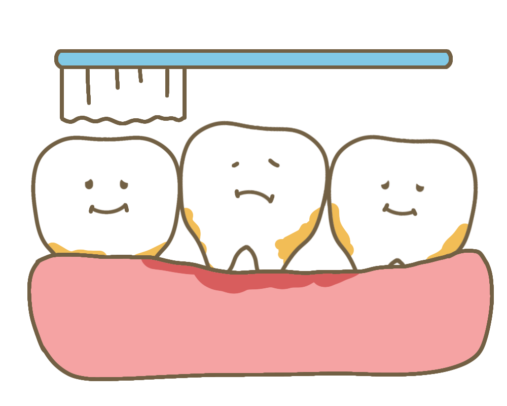 歯のグラグラの大半は歯周病が原因
