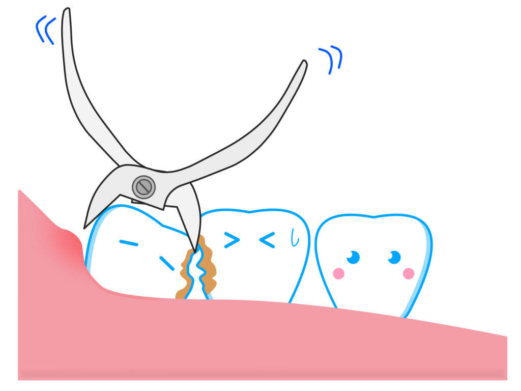 親知らず周りの炎症の治療法