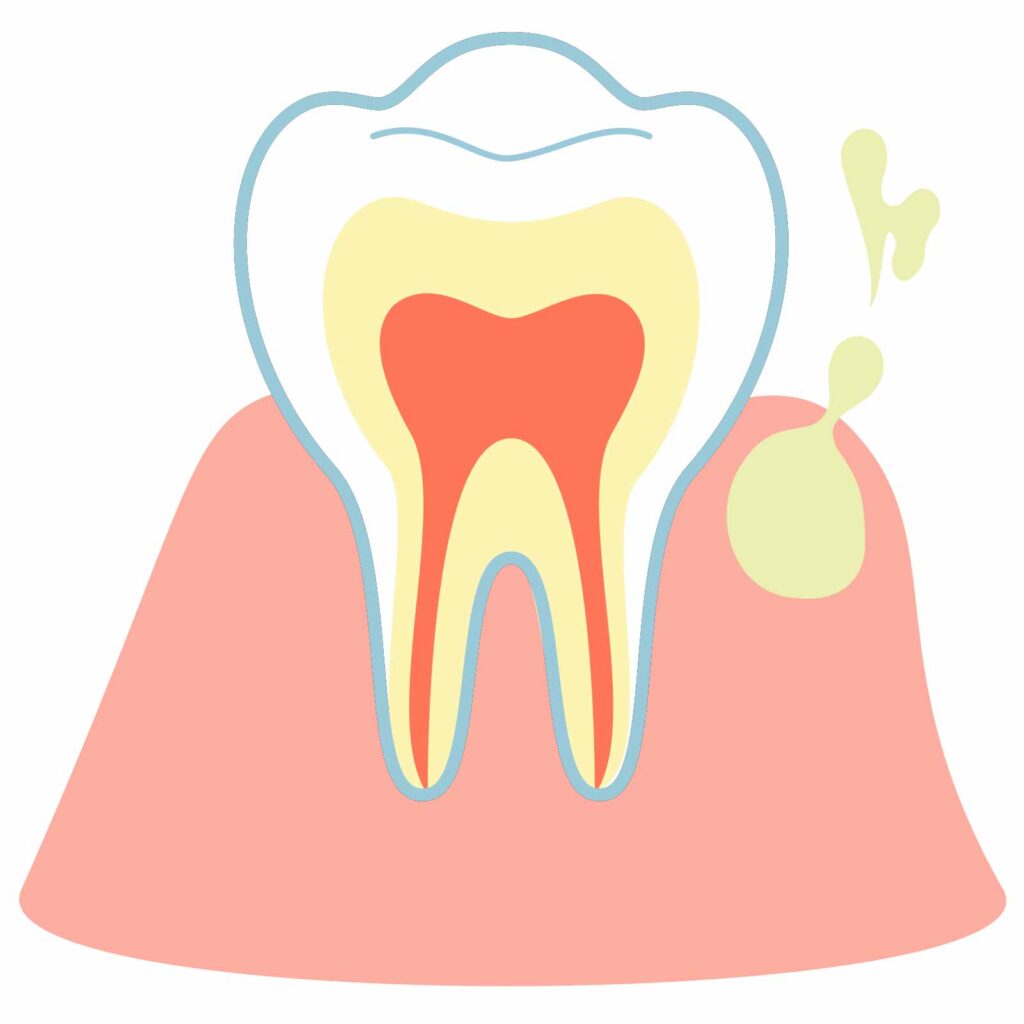 歯ぐきに膿がたまっているときの症状