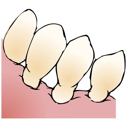 歯ぐきが痩せるとは？