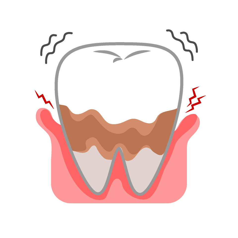 歯槽膿漏（重度歯周炎）