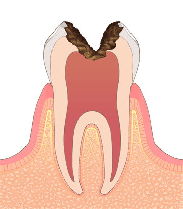 歯髄炎：虫歯が進行して炎症を起こした状態