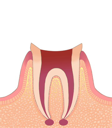 根尖性歯周炎：歯の根の先に炎症が起きて膿がある状態