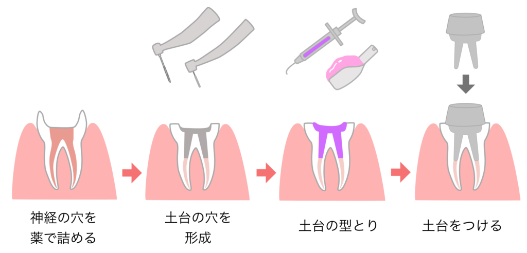 根管治療の流れ