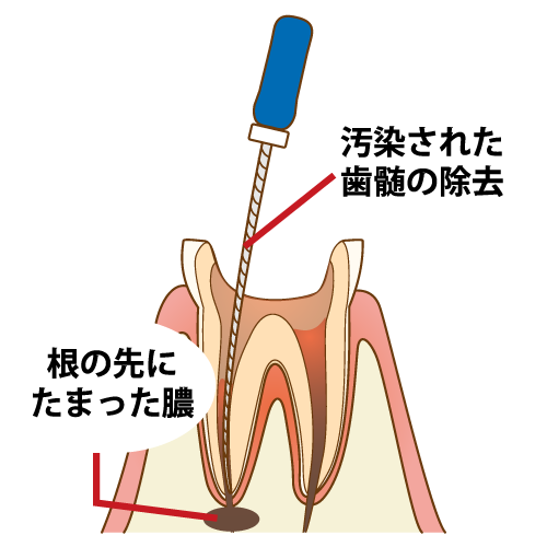 感染根管治療：歯の根の細菌感染を取り除く治療