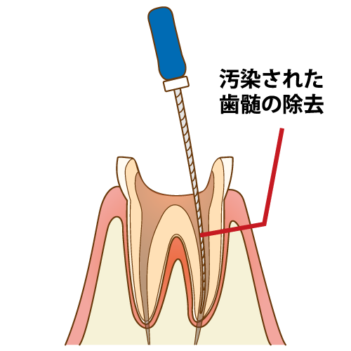 ②根管の神経・感染部分を掃除