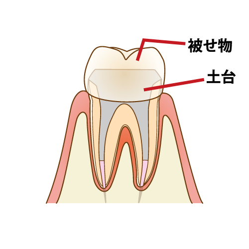 ⑤被せ物を作成・治療