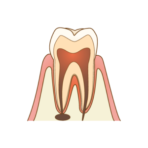 ②歯髄炎（しずいえん）