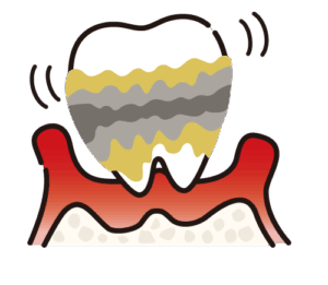 重度歯周炎:歯が大きく動揺し噛むのも困難