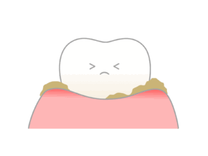 歯肉炎:歯ぐきが赤く腫れて出血しやすい