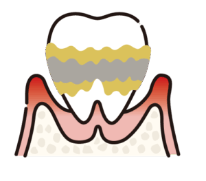 中等度歯周炎:歯がぐらつき膿や口臭も現れる