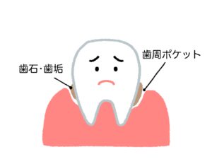 歯周ポケットとは?
